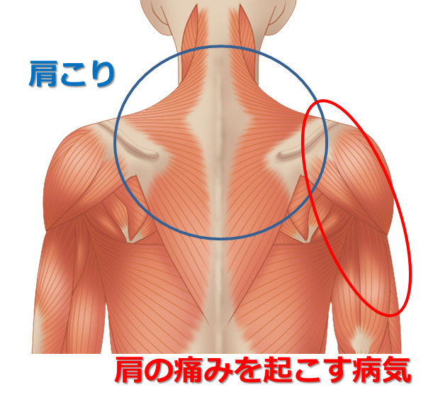 肩 と 腕 の 付け根 が 痛い