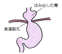 食道裂孔ヘルニア